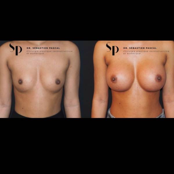 Poitrine – Augmentation mammaire par prothèse (3)