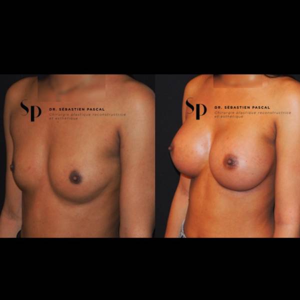 Poitrine – Augmentation mammaire par prothèse (3)