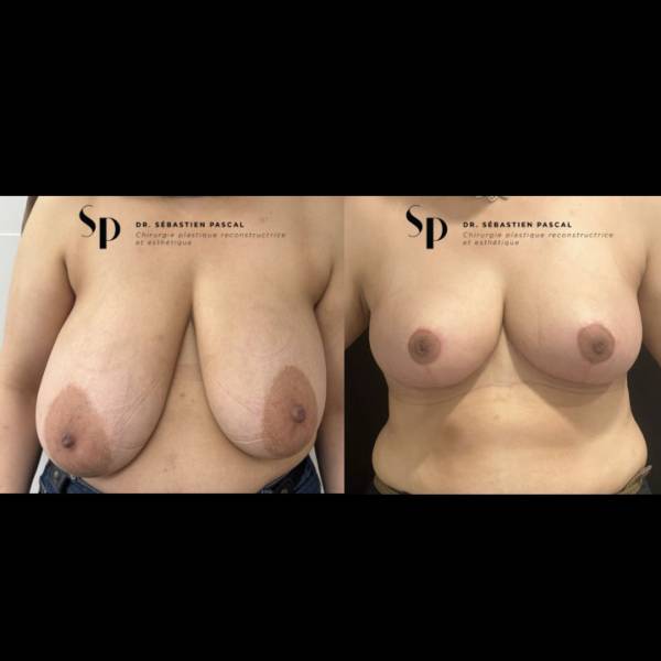 Poitrine – Réduction mammaire et hypertrophie mammaire