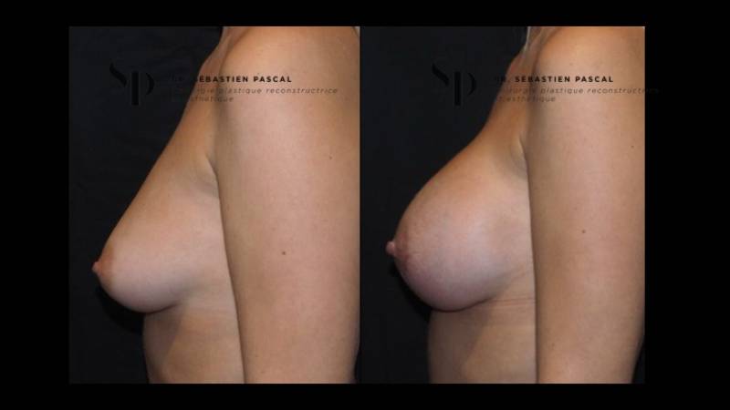 Poitrine – Augmentation mammaire par prothèse (3)