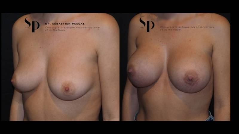 Poitrine – Augmentation mammaire par prothèse (3)