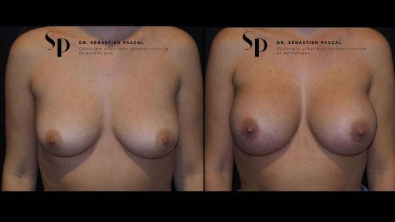 Poitrine – Augmentation mammaire par prothèse (2)