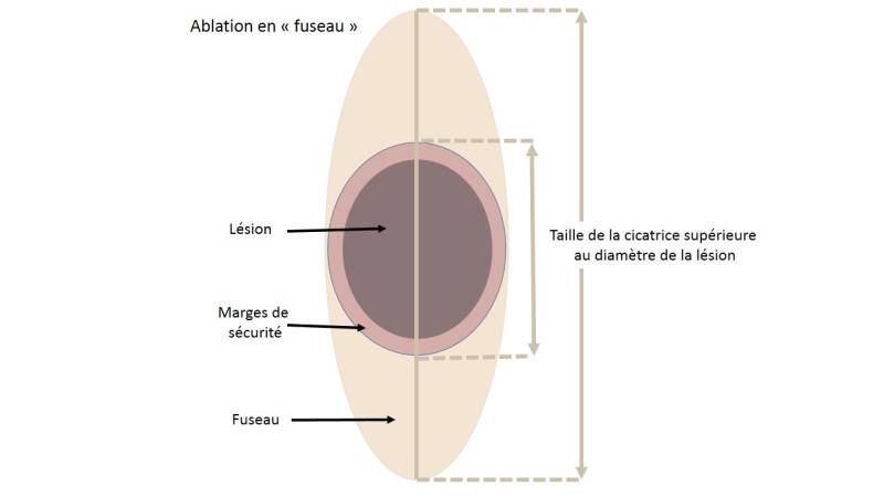 Dermatochirurgie ou Chirurgie des Lésions Cutanées