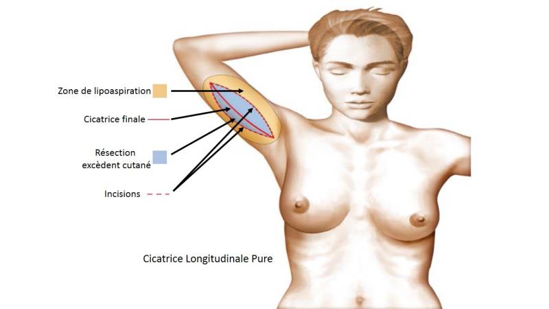 Lifting de Bras ou Dermolipectomie Brachiale