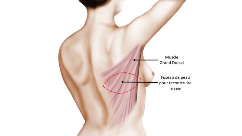 Reconstruction Mammaire par Lambeau de Muscle Grand Dorsal