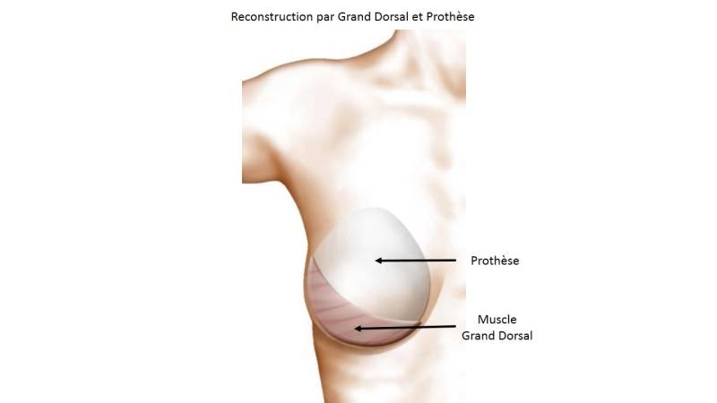 Reconstruction Mammaire par Lambeau de Muscle Grand Dorsal