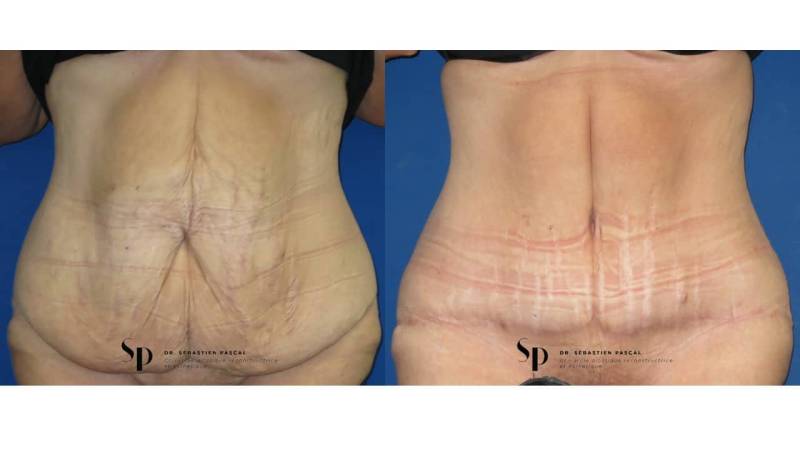 Silhouette - Abdominoplastie ou lifting du ventre