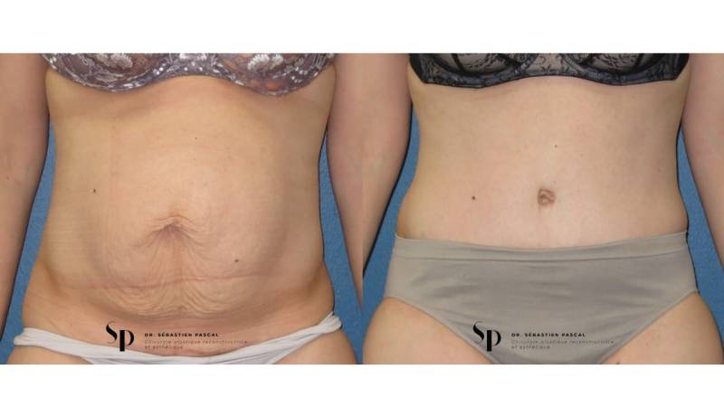 Silhouette - Abdominoplastie ou lifting du ventre