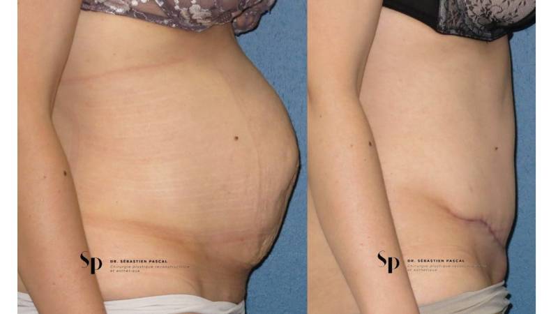 Silhouette - Abdominoplastie ou lifting du ventre
