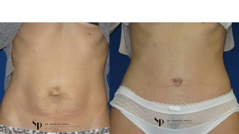 Silhouette - Abdominoplastie ou lifting du ventre