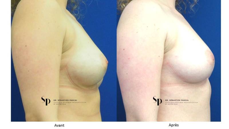 Poitrine – Augmentation mammaire par prothèse