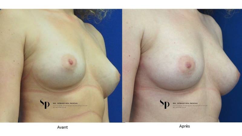 Poitrine – Augmentation mammaire par prothèse