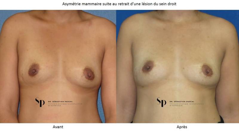 Poitrine – Augmentation mammaire par prothèse