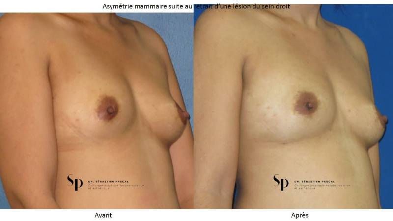 Poitrine – Augmentation mammaire par prothèse