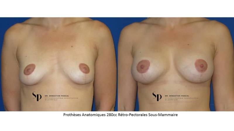 Poitrine – Augmentation mammaire par prothèse (2)