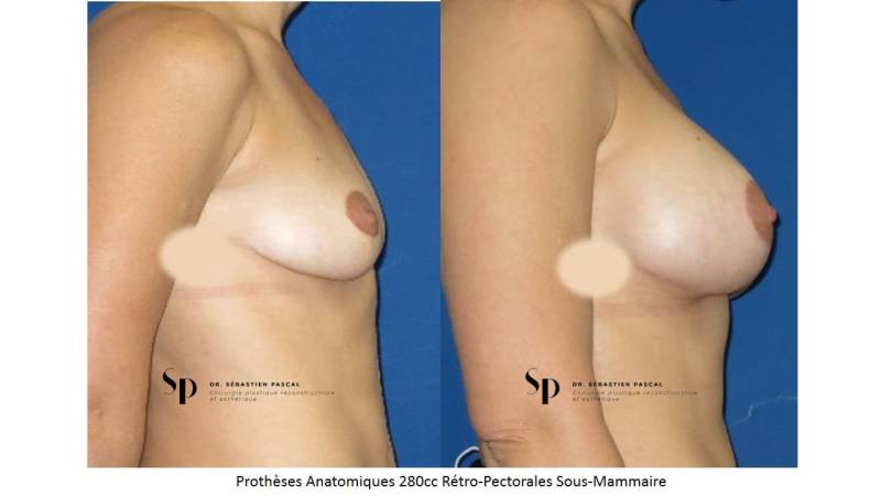 Poitrine – Augmentation mammaire par prothèse (2)