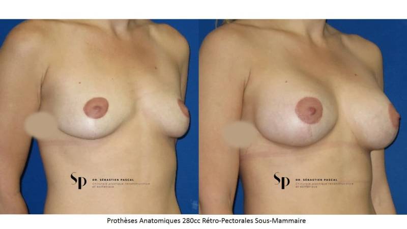 Poitrine – Augmentation mammaire par prothèse (2)