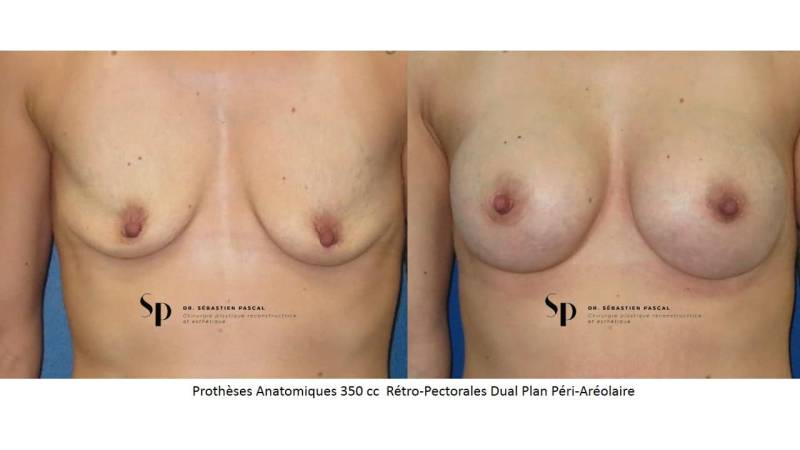 Poitrine – Augmentation mammaire par prothèse (2)