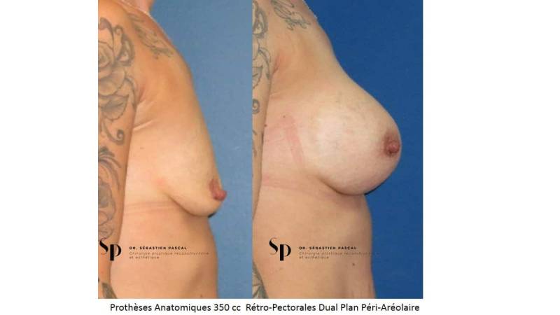 Poitrine – Augmentation mammaire par prothèse (2)
