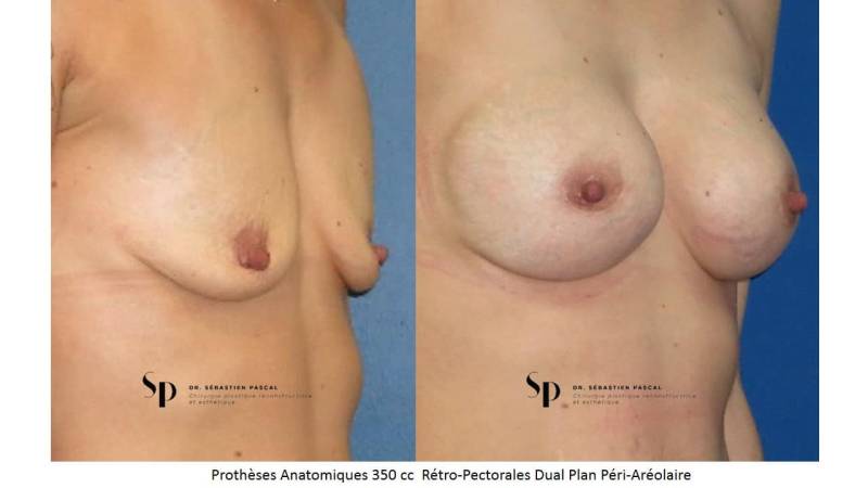 Poitrine – Augmentation mammaire par prothèse (2)