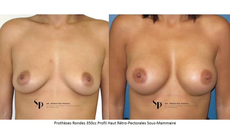 Poitrine – Augmentation mammaire par prothèse (2)