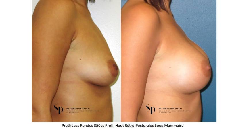 Poitrine – Augmentation mammaire par prothèse (2)