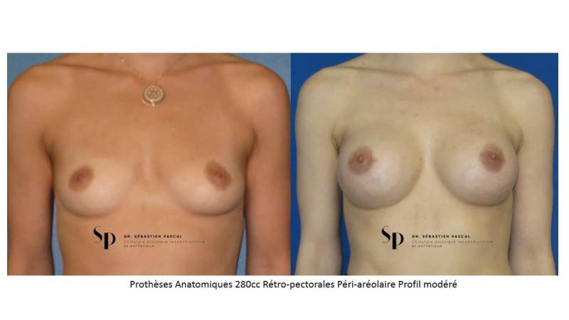 augmentation mammaire par prothèse - IMAGE AVANT / APRES par chirurgien esthétique