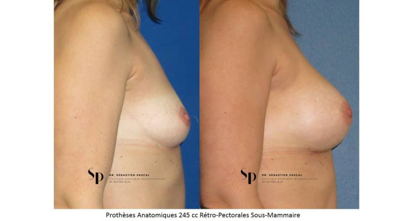 Poitrine – Augmentation mammaire par prothèse