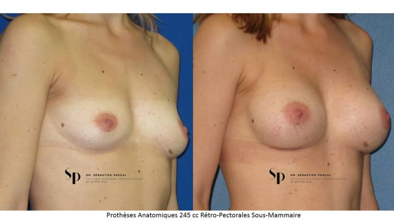 Poitrine – Augmentation mammaire par prothèse