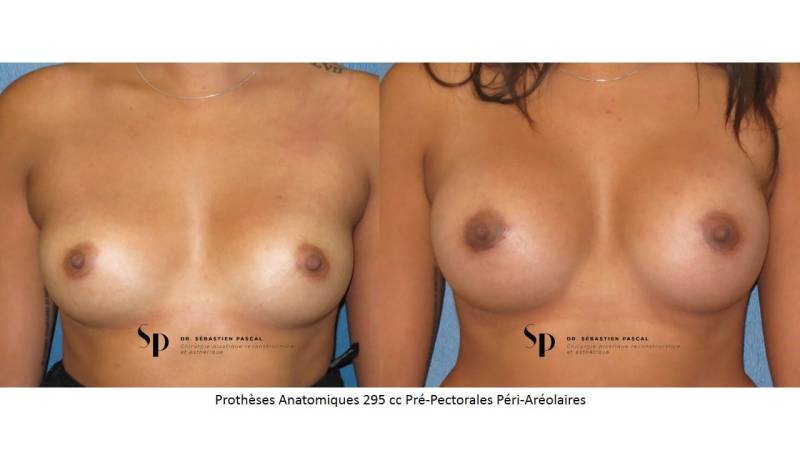 Poitrine – Augmentation mammaire par prothèse
