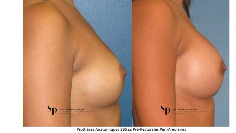 Poitrine – Augmentation mammaire par prothèse