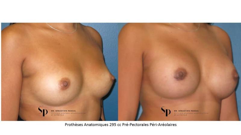 Poitrine – Augmentation mammaire par prothèse