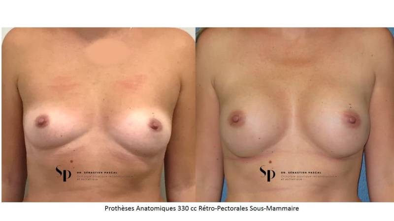 Poitrine – Augmentation mammaire par prothèse