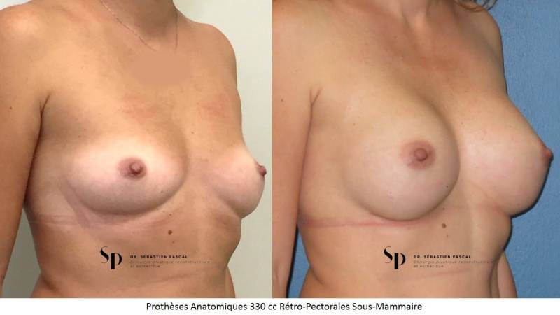 Poitrine – Augmentation mammaire par prothèse
