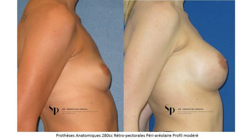 augmentation mammaire par prothèse - IMAGE AVANT / APRES 