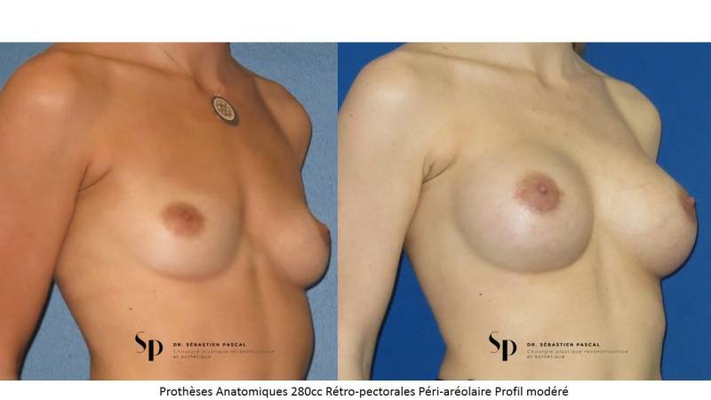 augmentation mammaire par prothèse - IMAGE AVANT / APRES 