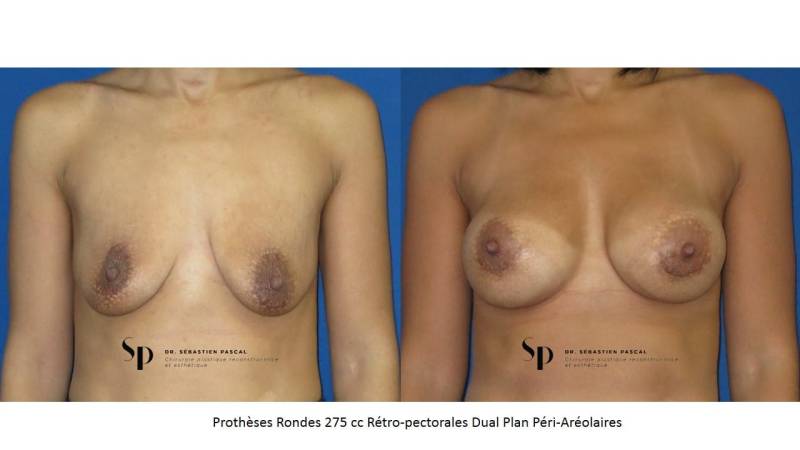Poitrine – Augmentation mammaire par prothèse (2)