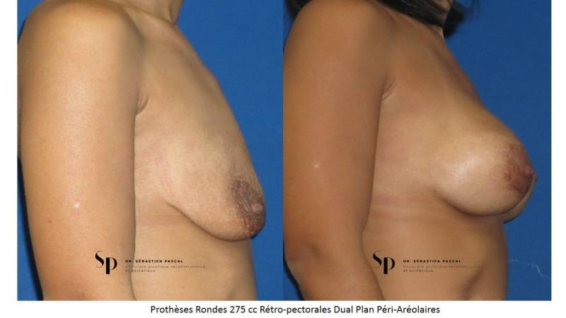augmentation mammaire par prothèse - IMAGE AVANT / APRES 