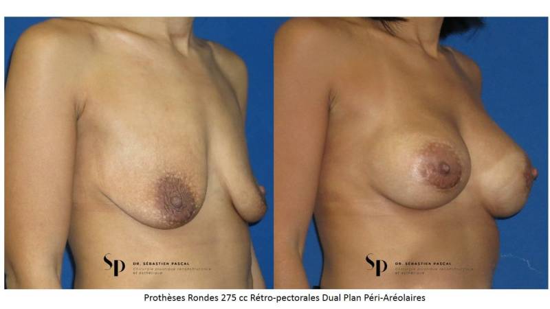Poitrine – Augmentation mammaire par prothèse (2)