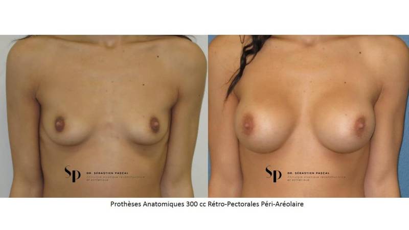 Poitrine – Augmentation mammaire par prothèse (2)