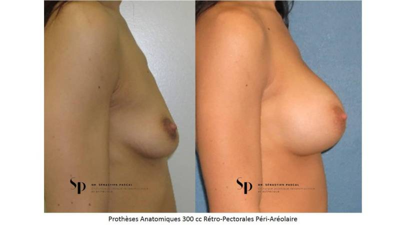 Poitrine – Augmentation mammaire par prothèse (2)