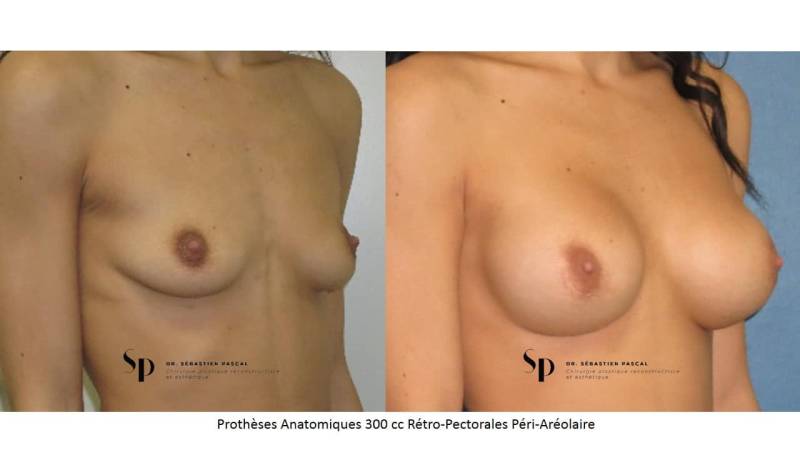 Poitrine – Augmentation mammaire par prothèse (2)