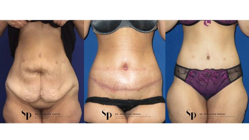 Bodylift ou Dermolipectomie Totale Circulaire