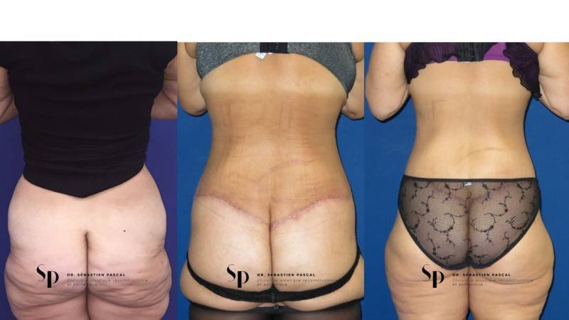 Silhouette - Bodylift