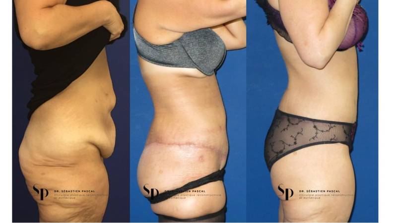 Silhouette - Bodylift