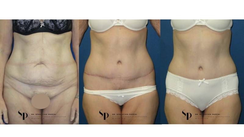 Silhouette - Bodylift