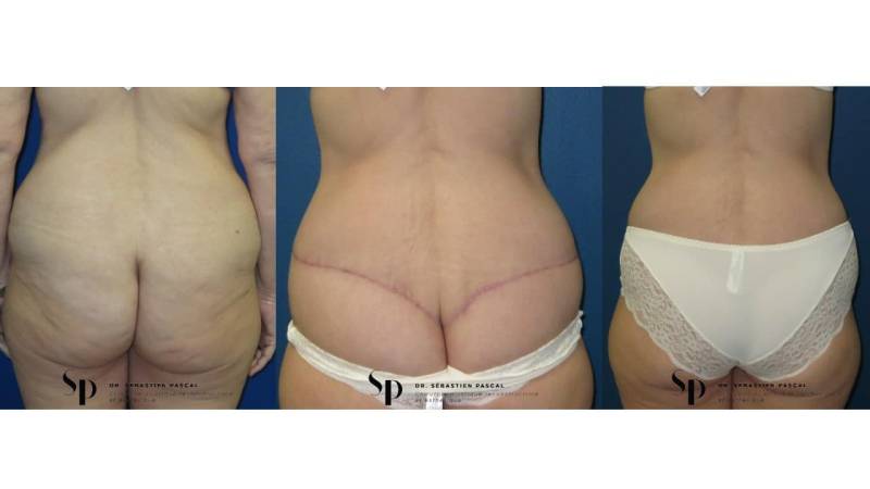 Silhouette - Bodylift