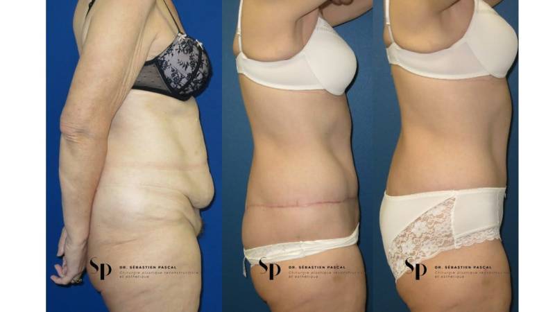 Silhouette - Bodylift