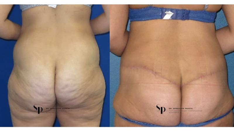 Silhouette - Bodylift