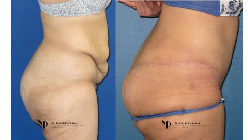 Silhouette - Bodylift